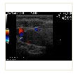 ecocolor doppler tiroide