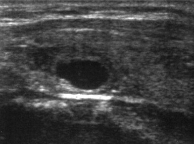 ecografia della tiroide